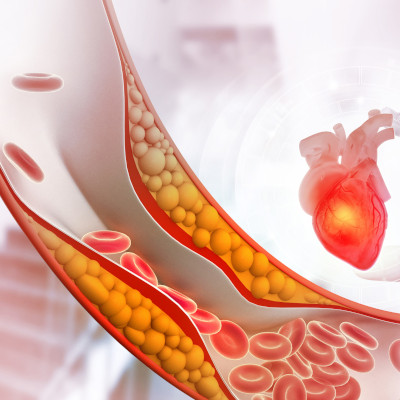 Cholesterin-Ansammlungen in den Arterien
